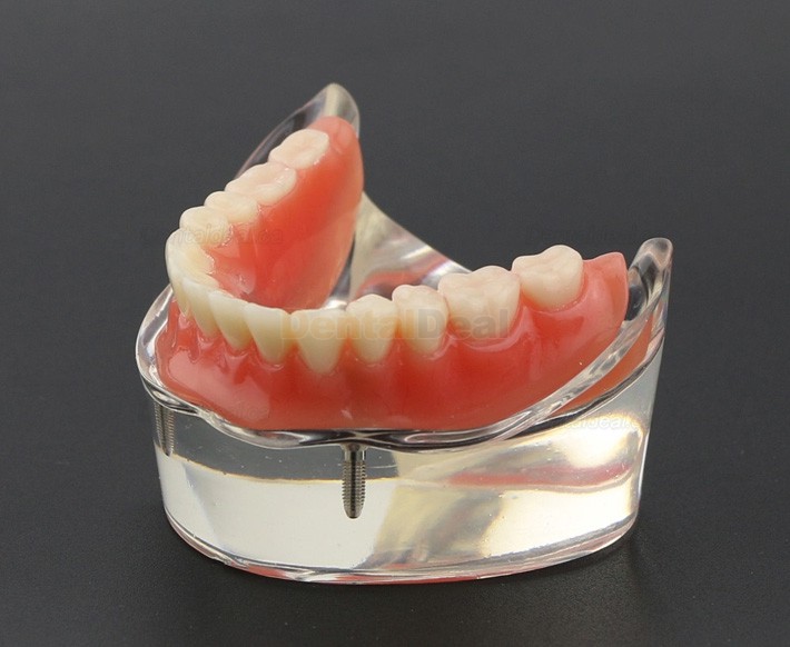 Dental Teeth Implant Overdenture Model Lower Jaw with 2 Implants Education Study Demo Model 6002 01